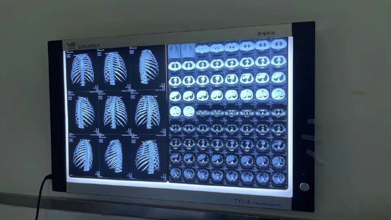 #苹果车祸检测或是人工客服 ，类似于汽车上面的安吉星救援最近短视频平台上一位 ID 为@喜猫 的小伙骑摩托车出了车祸，他当时戴着的正是刚刚购买几天的 Apple Watch Ultra 智能手表，这次车祸触发了苹果的车祸检测模式